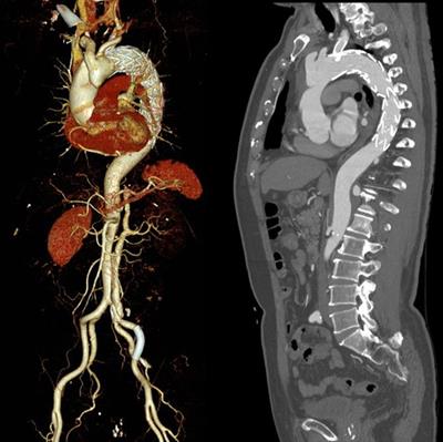 Thoracic endovascular aortic repair under venoarterial extracorporeal membrane oxygenation for acute aortic dissection patients: a case report